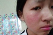 脸上有狗皮癣长什么样？（了解狗皮癣在脸部的特征和症状）