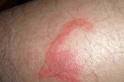 全身红包痒，你可能患上了什么病？（探索红包痒背后的真相及解决方法）