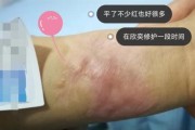 泰迪烫伤或烧伤怎么办？（宠物的疼痛，主人的责任；应急措施教你救急。）
