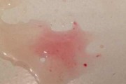 小便有血色代血丝可能患的疾病（详解小便有血色代血丝的病因和治疗方法）