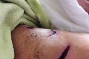 了解狂犬病的症状（掌握关键信息，保护自己和爱宠的安全）