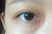 探究以眼睛长息肉的原因与治疗方法（深入了解眼睛长息肉的形成原因及预防措施）