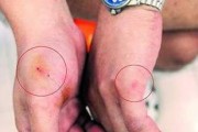 被宠物咬伤抓伤该如何处理（详细解读宠物咬伤抓伤的后果及应对方法）