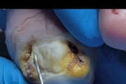 狗甲沟炎的症状与治疗（宠物狗甲沟炎常见症状及治疗方法解析）