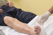 狗咬狗伤口处理方法（有效处理狗咬狗伤口，保护你的宠物健康与安全）
