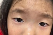 探究倒睫毛的原因及解决办法（倒睫毛的影响和常见原因分析）