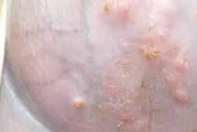 狗狗毛囊炎（了解狗狗毛囊炎的主要原因和有效的预防方法）